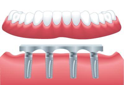 Implant Supported Dentures in Burley, ID