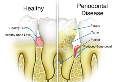 Gum Disease and Tooth and Bone Loss Burley, ID