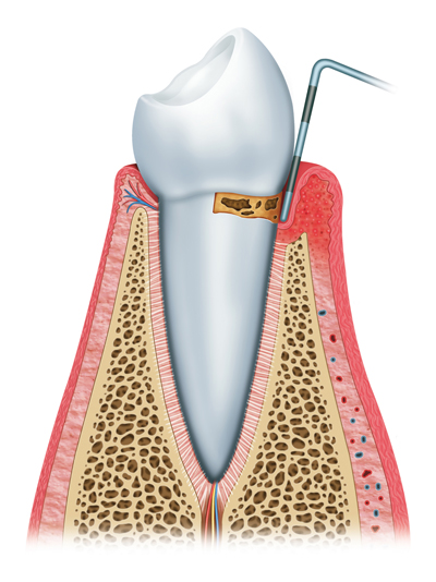 Stages of Gum Disease Burley, ID